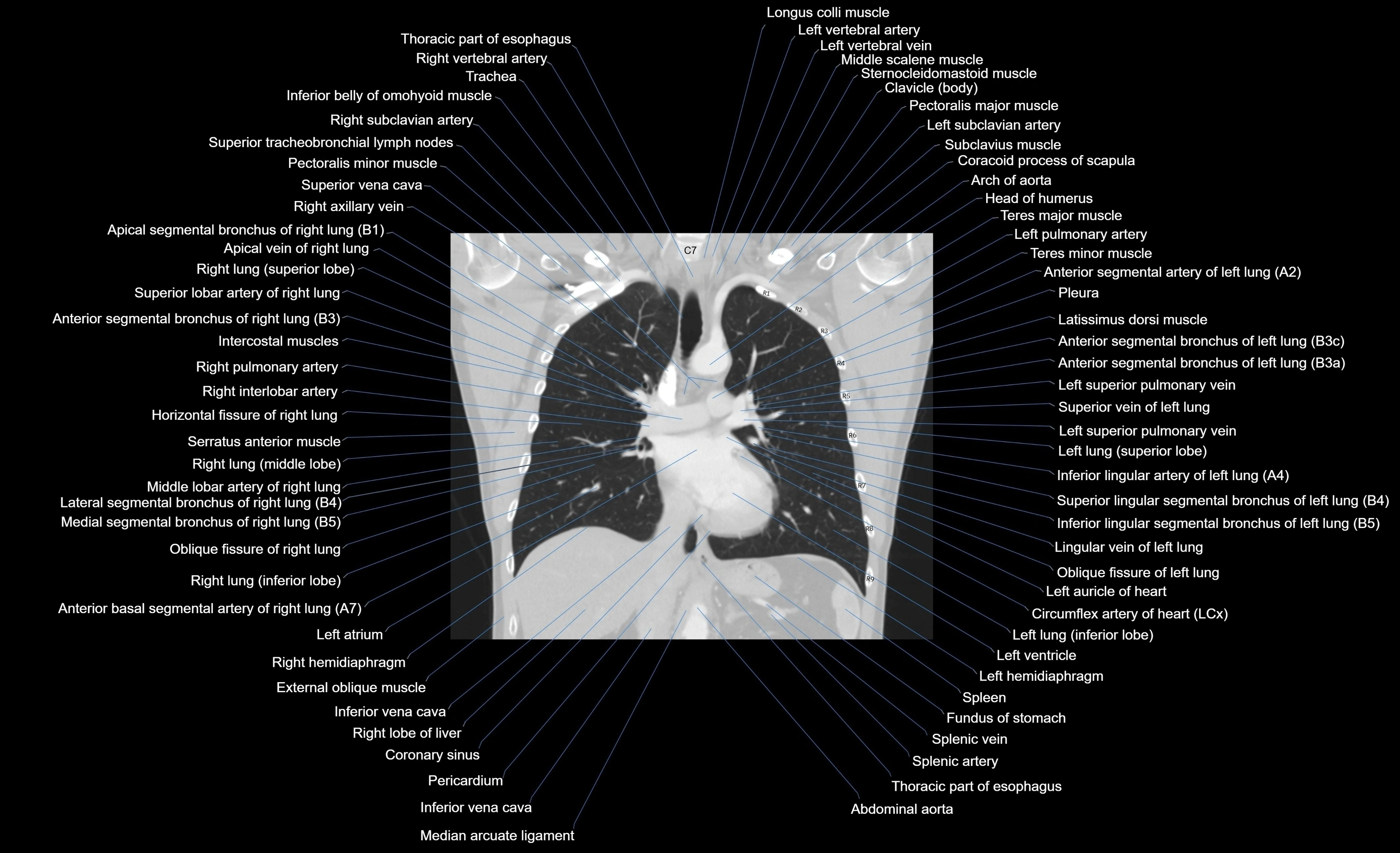 CT chest (thorax) lung window window labelled coronal cross sectional anatomy radiology image-00062.webp
